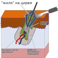 цирей - фурункул